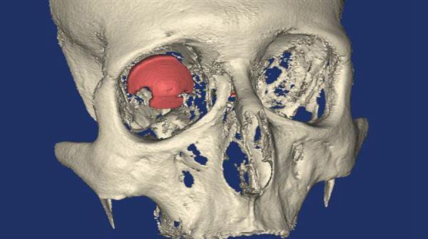 3D打印技術(shù)在醫(yī)療方面的應(yīng)用 世界首個3D打印義眼_E鍵3D打印服務(wù)