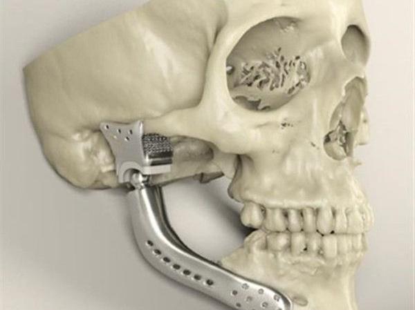 簡(jiǎn)述3D打印技術(shù)在醫(yī)療行業(yè)應(yīng)用情況_e鍵3D打印服務(wù)