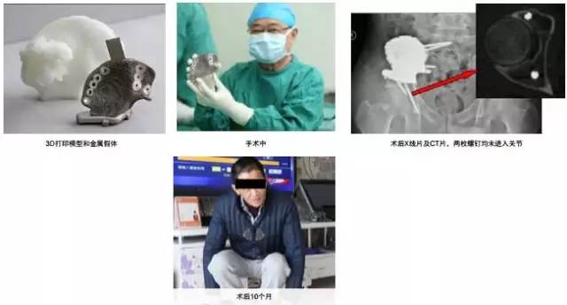 3d打印在醫(yī)療領(lǐng)域的應(yīng)用 3D打印與醫(yī)療行業(yè)白皮書