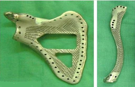 3d打印應(yīng)用領(lǐng)域之醫(yī)療應(yīng)用_e鍵打印服務(wù)公司