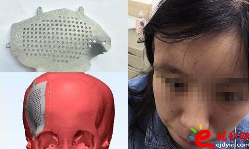 醫(yī)療3d打印應(yīng)用,醫(yī)用3d打印,3D打印假肢,3D打印脊椎,3D打印心臟,e鍵打印,3d打印服務(wù) 3D打印的顱骨假體，非常適用于發(fā)際外的顱骨缺損、病變置換，將使患者的面容恢復(fù)到正常形態(tài)，完美解決了傳統(tǒng)顱骨修補(bǔ)存在的美容問題。據(jù)悉，3D打印個(gè)性化顱骨假體修補(bǔ)技術(shù)已獲國家重點(diǎn)研發(fā)計(jì)劃資助，能為一批病人免費(fèi)提供假體，并能減免一些檢查和治療費(fèi)用。未來將實(shí)行72小時(shí)的3D假體個(gè)性化顱骨修補(bǔ)術(shù)，造福更多的患者。