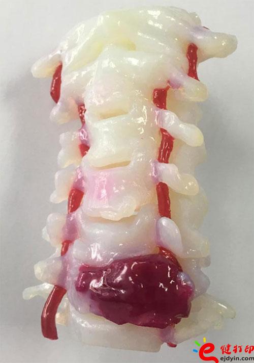 3D打印頸椎腫瘤