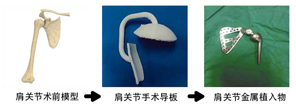 肩關(guān)節(jié)金屬植入物2