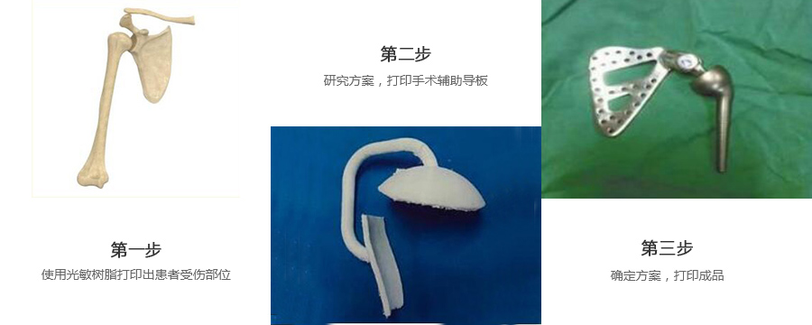 肩關(guān)節(jié)金屬植入物3d打印制作流程
